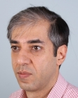 Before Hair Transplant&nbsp;2 Sessions (Areas)
